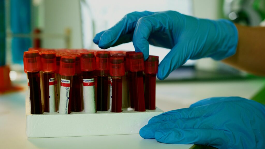 Serum peptide patterns for diagnostics of intracranial hemorrhagic stroke in humans and differential diagnosis of intracranial hemorrhagic stroke from acute ischemic stroke