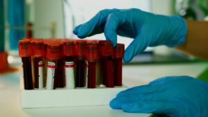 Wzorce peptydów w surowicy do diagnostyki śródczaszkowego udaru krwotocznego u ludzi i diagnostyki różnicowej śródczaszkowego udaru krwotocznego od ostrego udaru niedokrwiennego mózgu